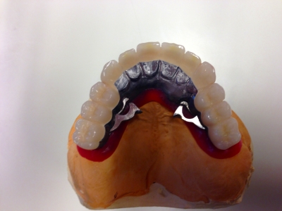 リーゲルテレスコープ義歯２