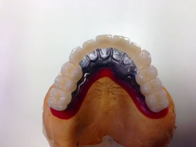 リーゲルテレスコープ義歯３