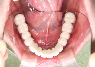 リーゲルテレスコープ義歯６