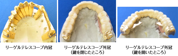 リーゲルテレスコープ義歯